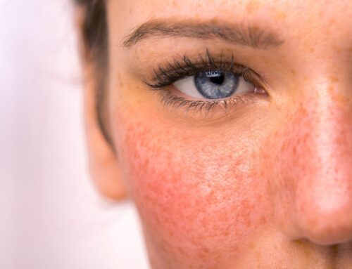 Understanding Rosacea: Causes, Symptoms, and Treatment Options