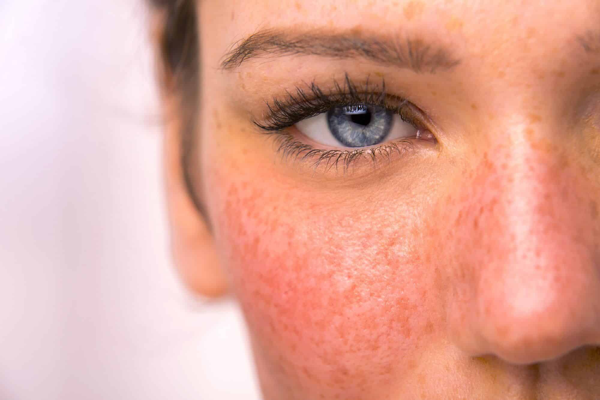 Rosacea, why do i have it?