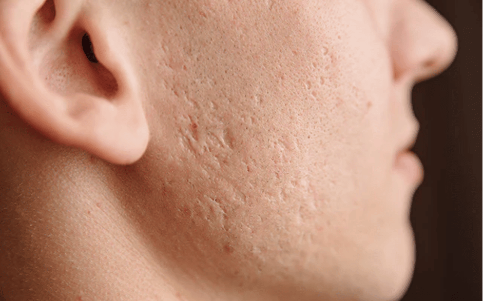 HOW CAN YOU HELP IMPROVE ACNE SCARRING?