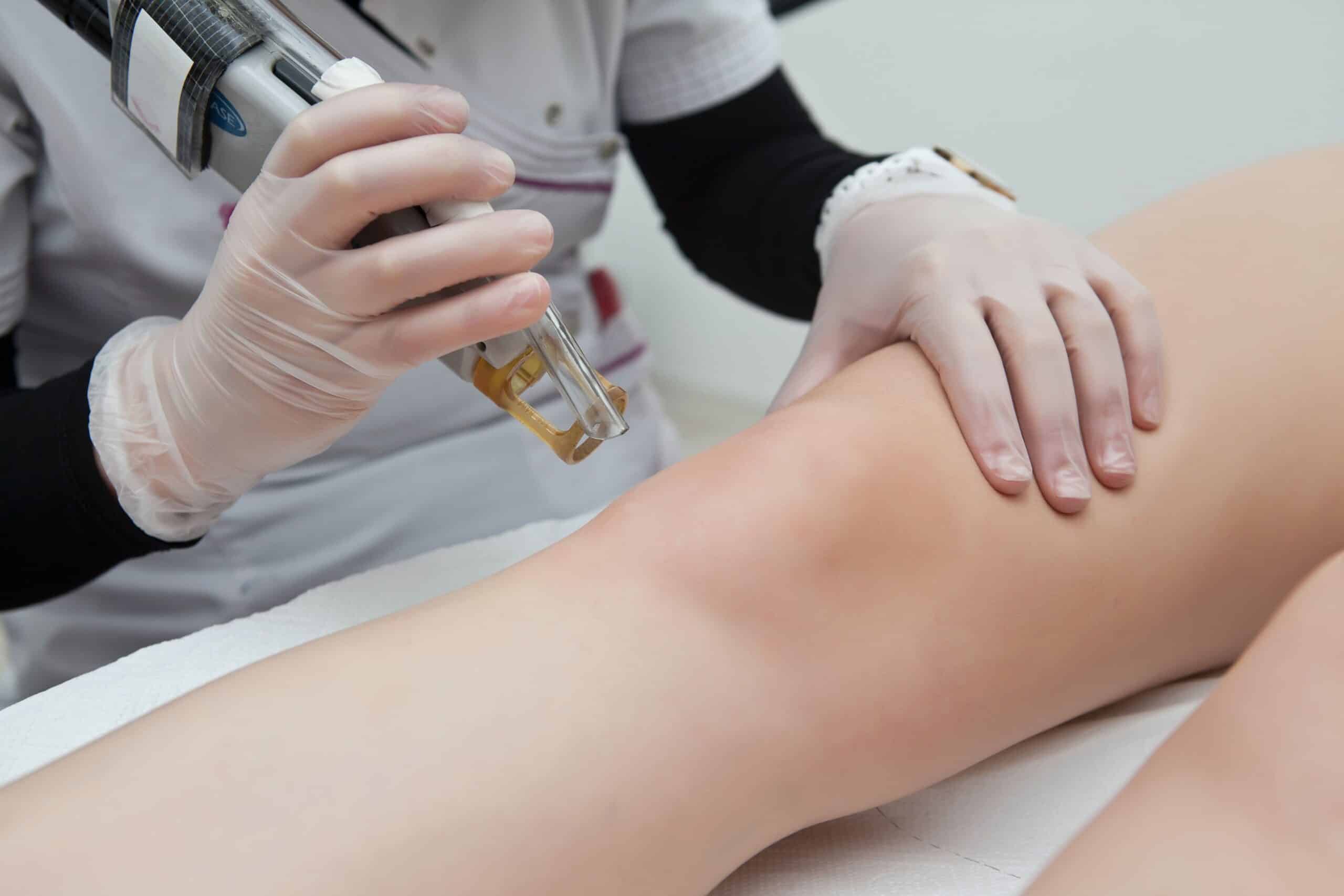 What to expect from Laser Hair Removal Treatment