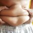 Treatment for Excess Fat In Brighton