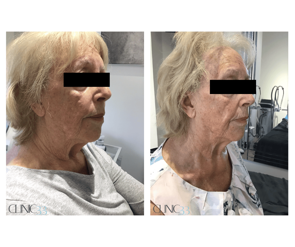 Jawline Contouring for elderly