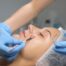 Chemical_peels_
