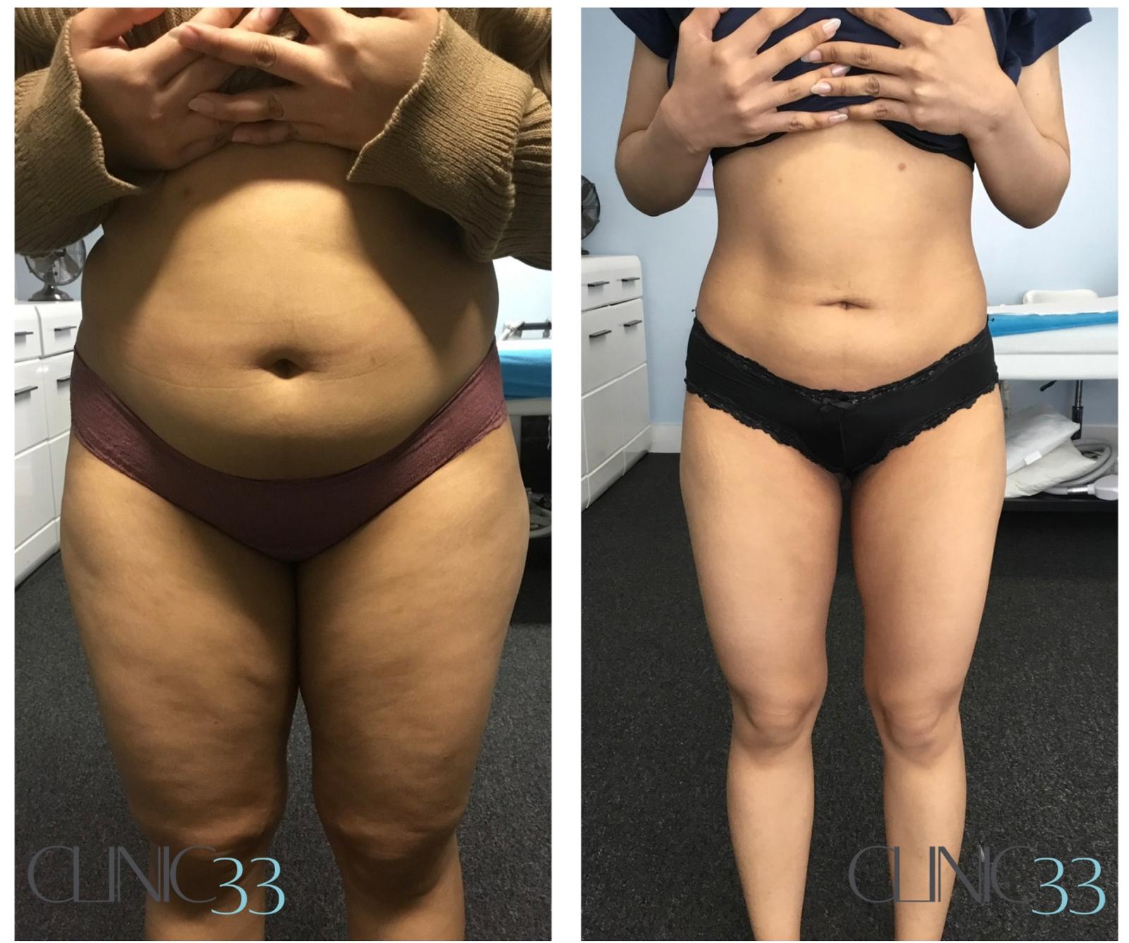 fat freezing results