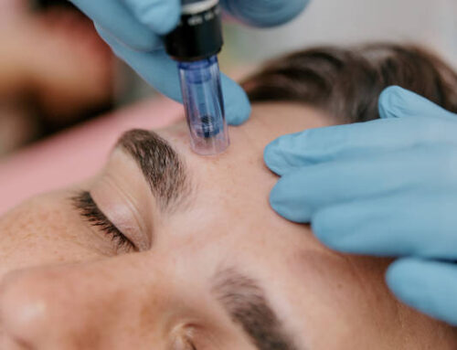 Microneedling: What to Expect Before, During, and After Treatment