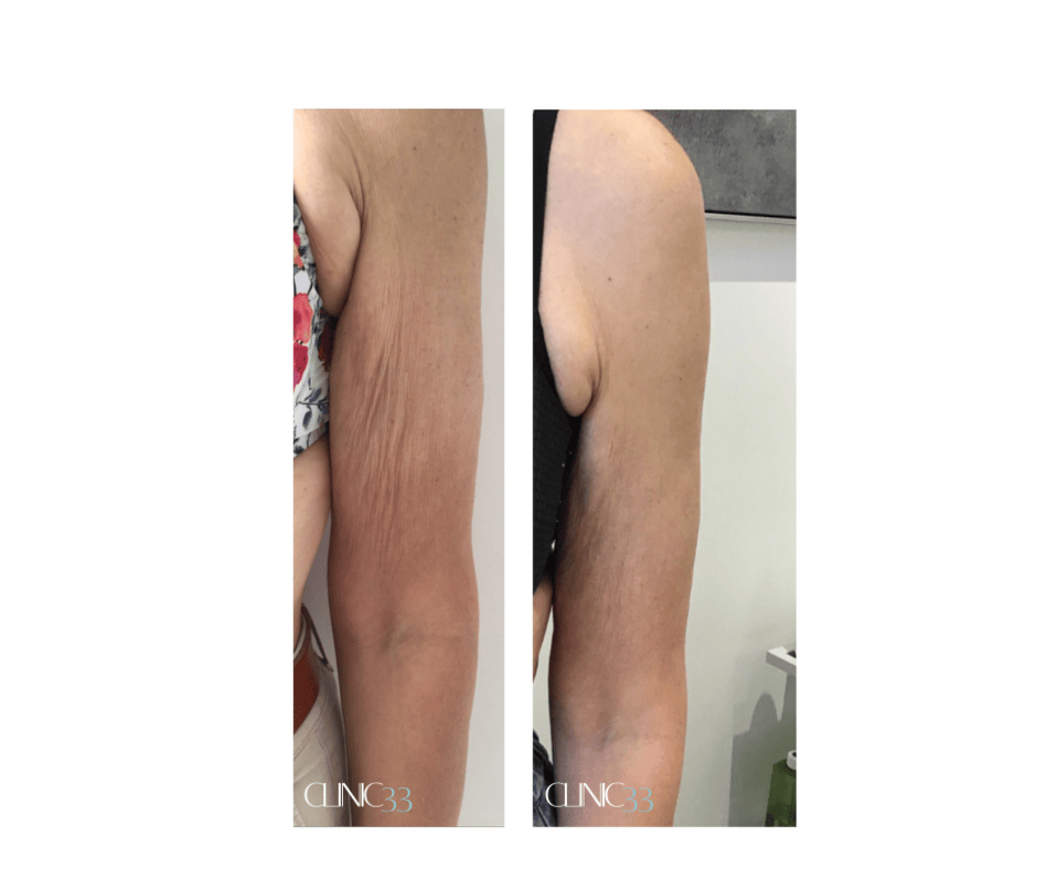 Lipoform Arms treatment