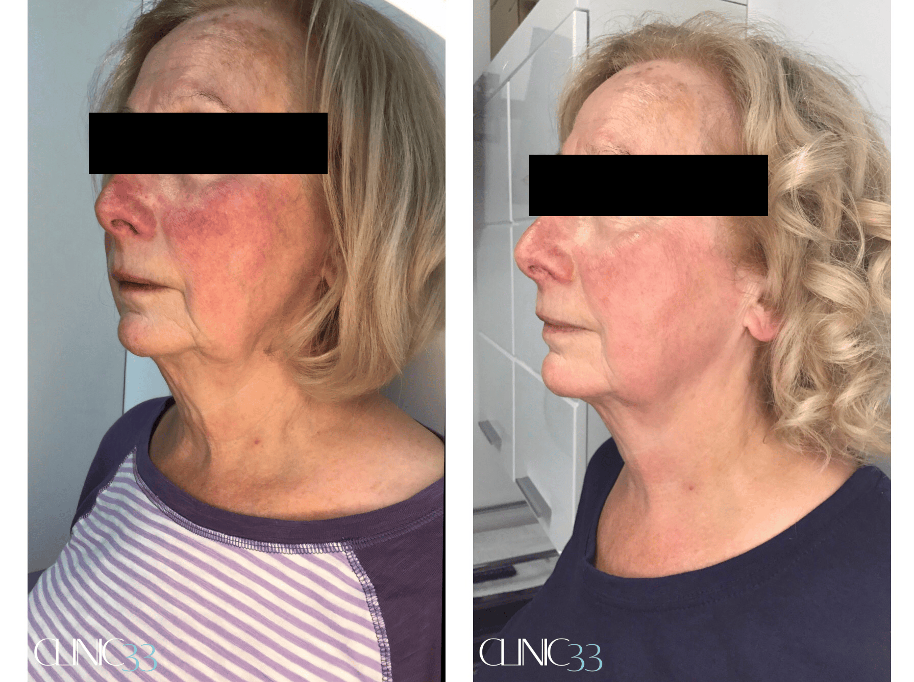 Facial Skin Tightening & Lifting