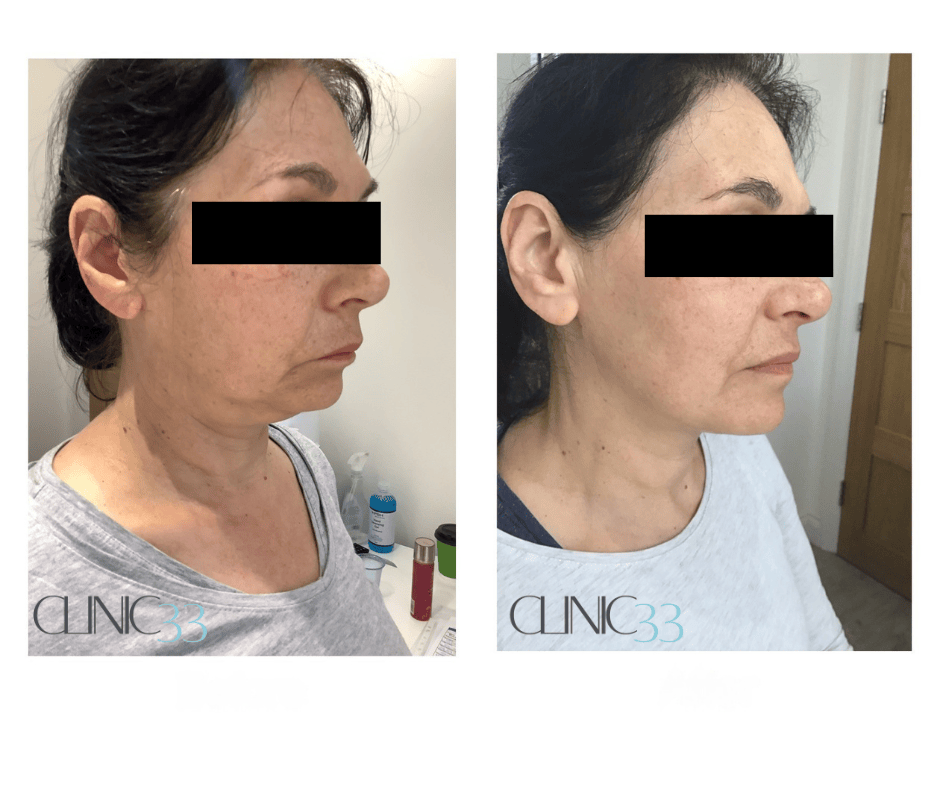 Jawline treatments
