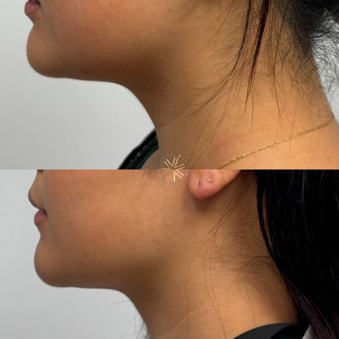 BEFORE AND AFTER SKIN TIGHTENING & WRINKLE TREATMENT
