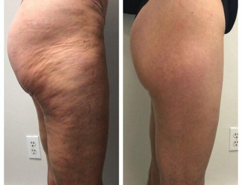 Tackling Cellulite on the Back of Legs