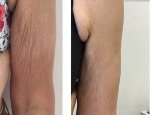 Fat Freezing for Arms: What to Expect and When You’ll See Results