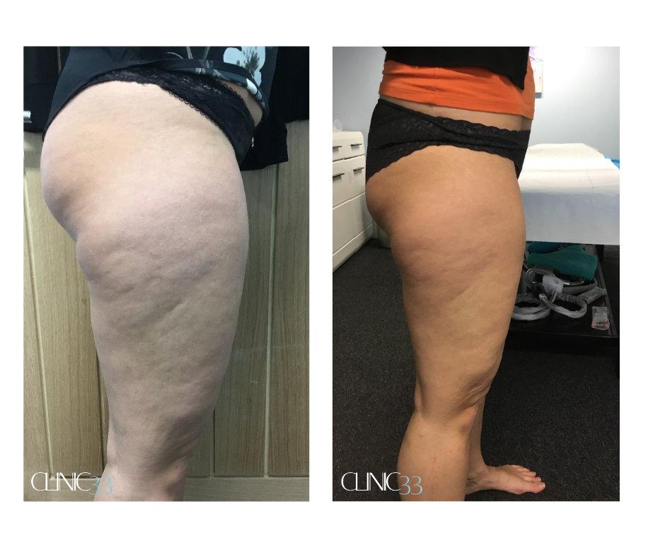 B&A lipofirm legs