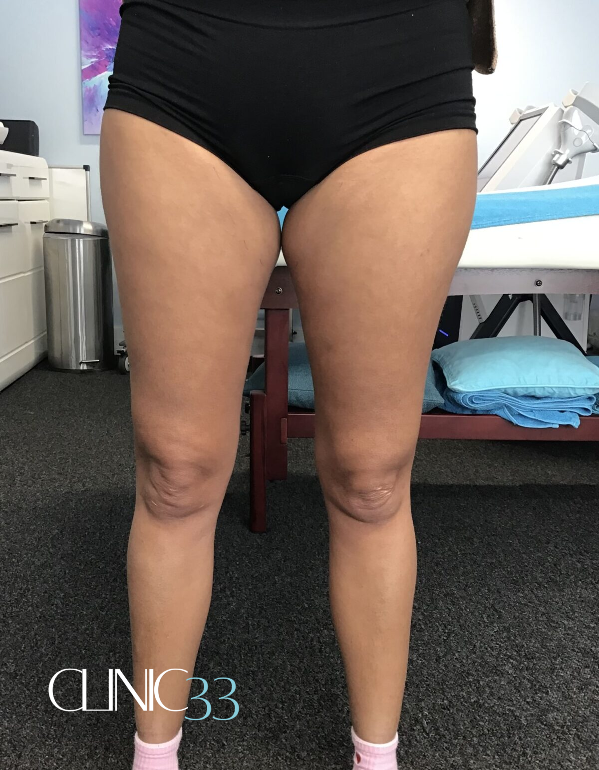What is cellulite?