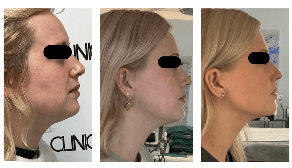 Jawline - double chin fat reduction - skin tightening and lifting - clinic 33, Brighton & Hove