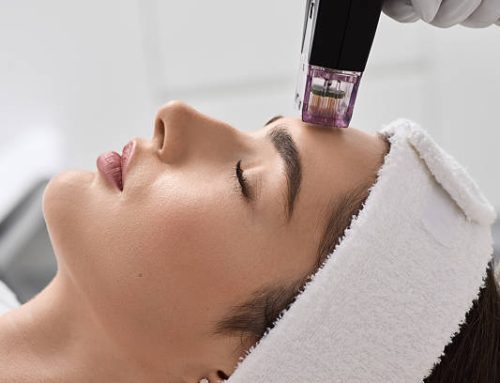 Microneedling: What to Expect, Benefits and Aftercare